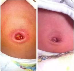 新手媽媽過分 照顧 寶寶臍帶引發(fā)臍炎 這幾個(gè)常見的新生兒護(hù)理問題最需謹(jǐn)惕