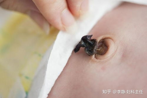 肚臍眼里黑色的臟東西能摳嗎 它們到底是什么