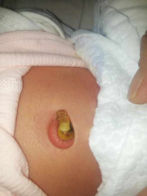 榆陽(yáng)區(qū)婦幼保健院產(chǎn)房新技術(shù) 新生兒無(wú)包扎臍部護(hù)理與臍帶護(hù)理液的創(chuàng)新應(yīng)用